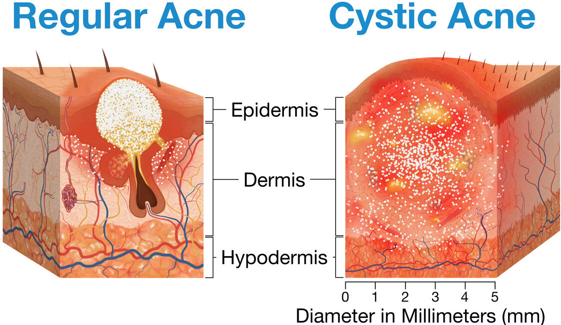 Cyst vs Pimple