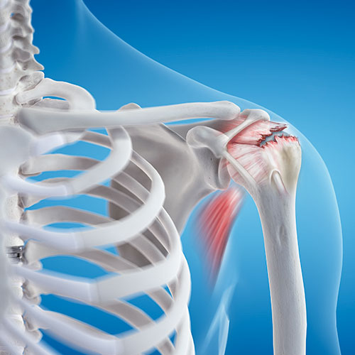 Rotator Cuff Tears