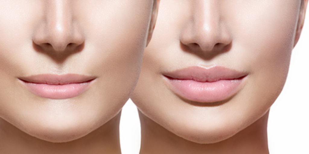 Lip Fillers