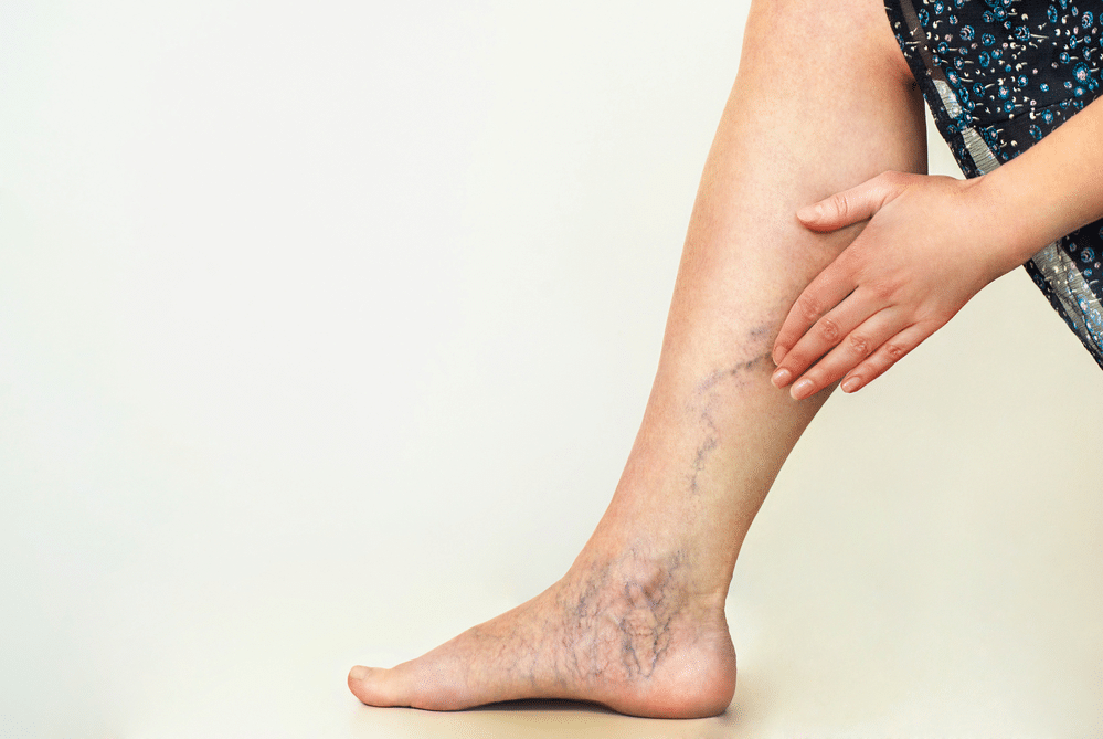 Varicose Veins