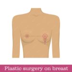 Breast Reduction Surgery