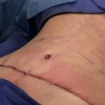 Abdominoplasty