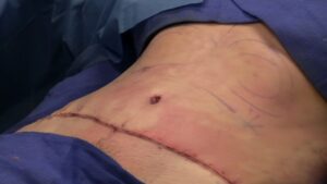 Abdominoplasty