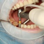 Front Dental Implants