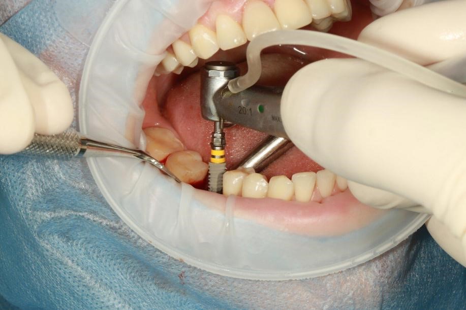 Front Dental Implants