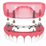 Implant Supported Dentures