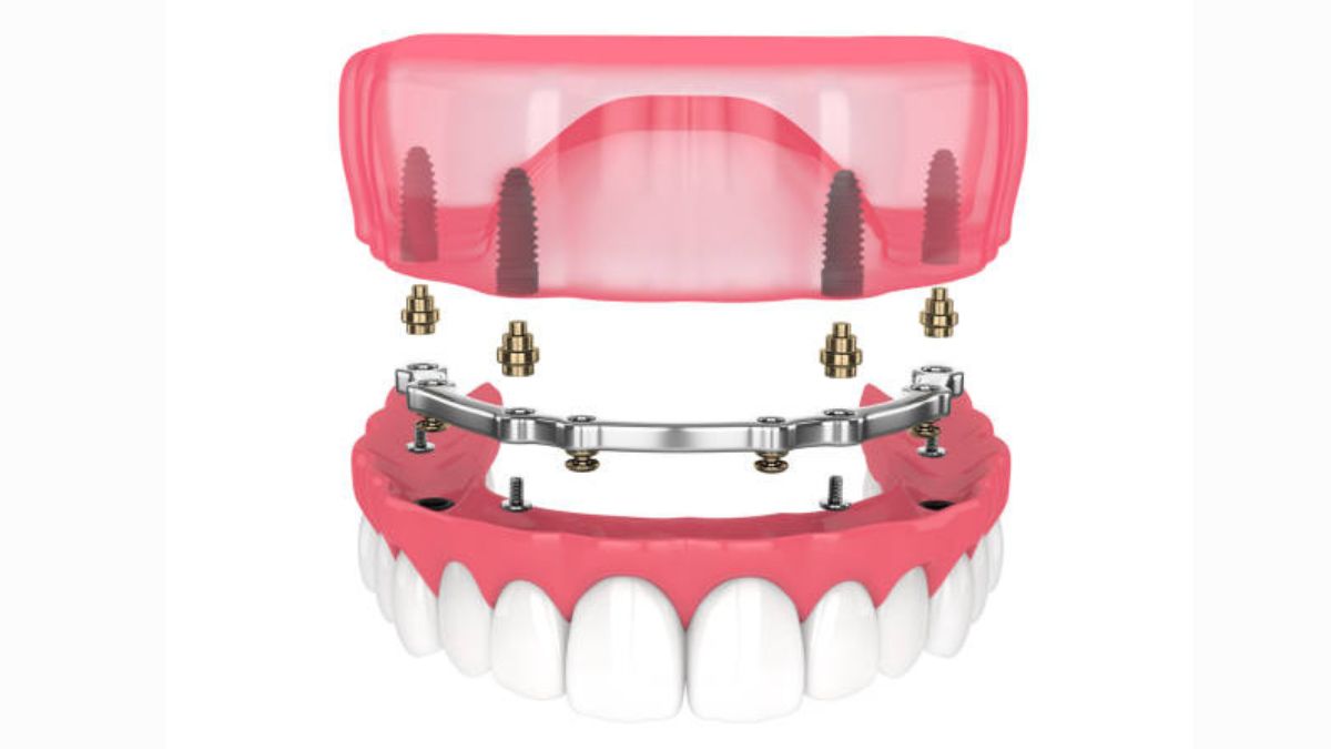 Implant Supported Dentures