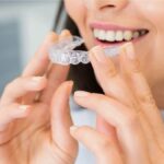 Invisalign Aligners