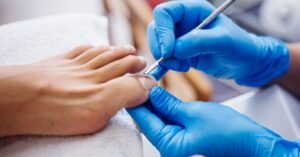 Ingrown Toenails