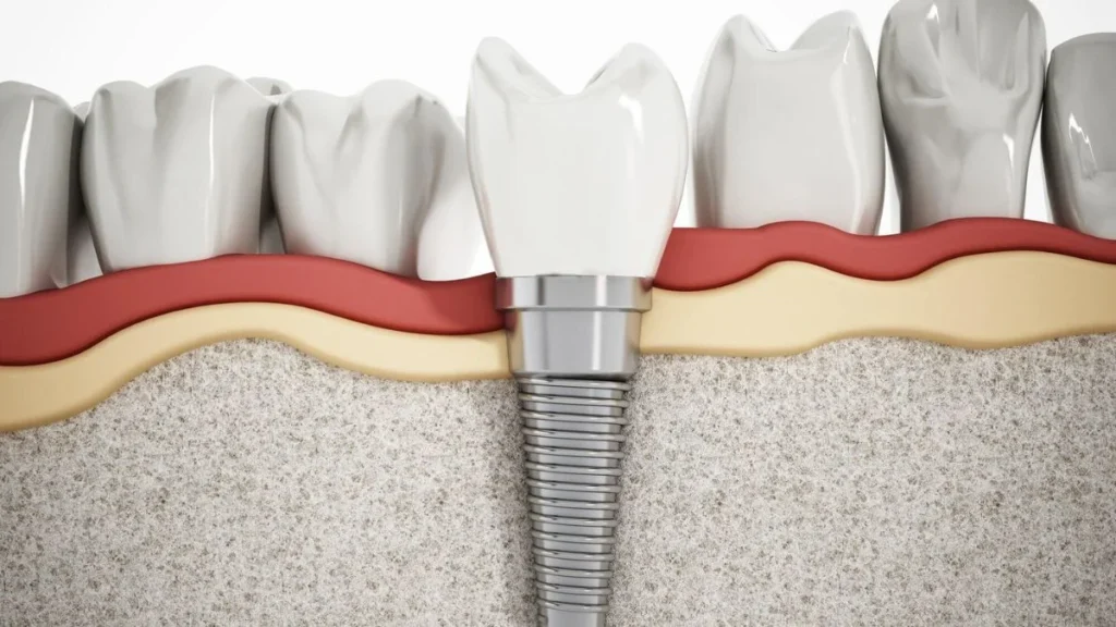 Dental Implant