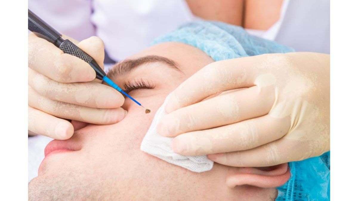 Get Rid of Moles