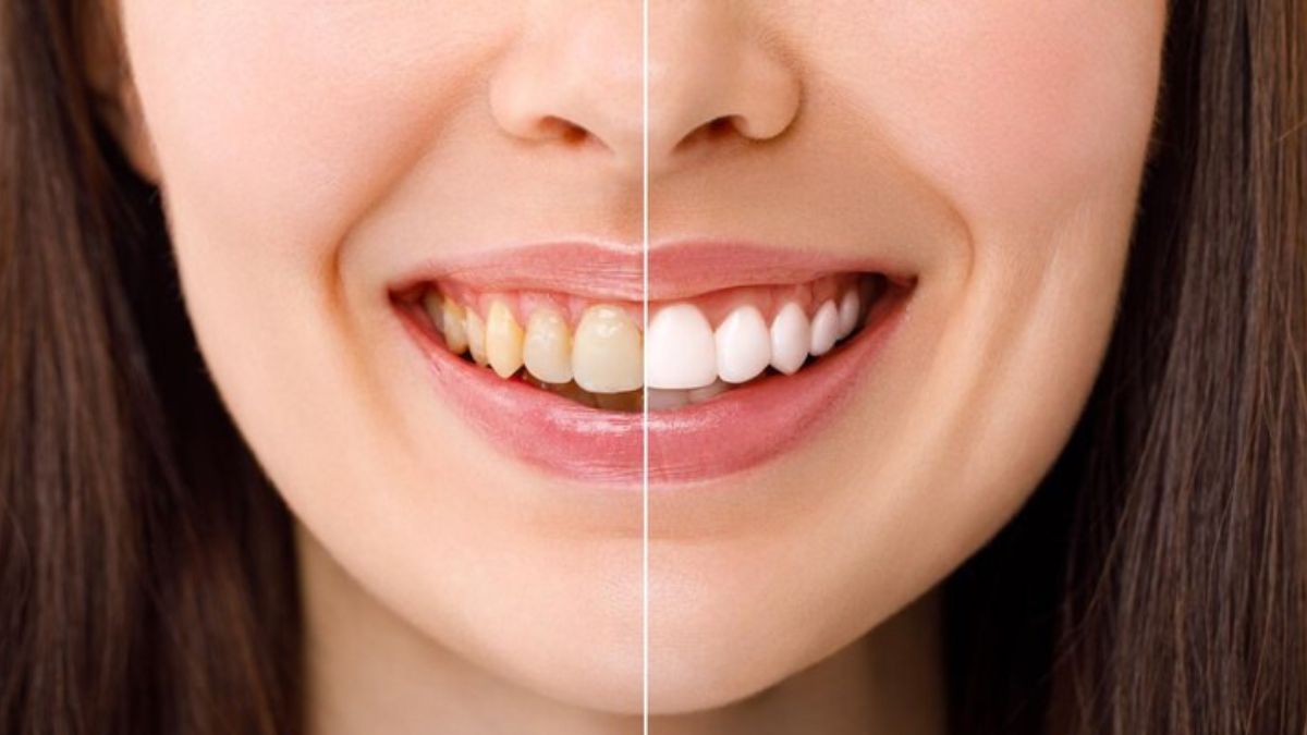 Whitening Services
