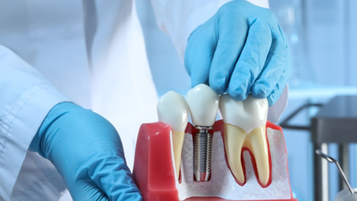 Full-Arch Teeth