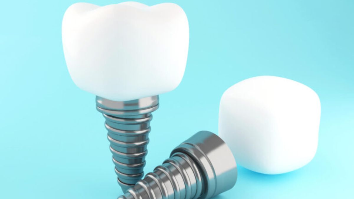Dental Implants