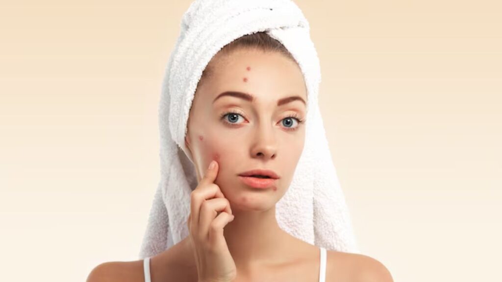 Can Hyaluronic Acid Cause Acne