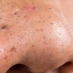 Blackheads on the Nose
