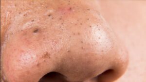Blackheads on the Nose