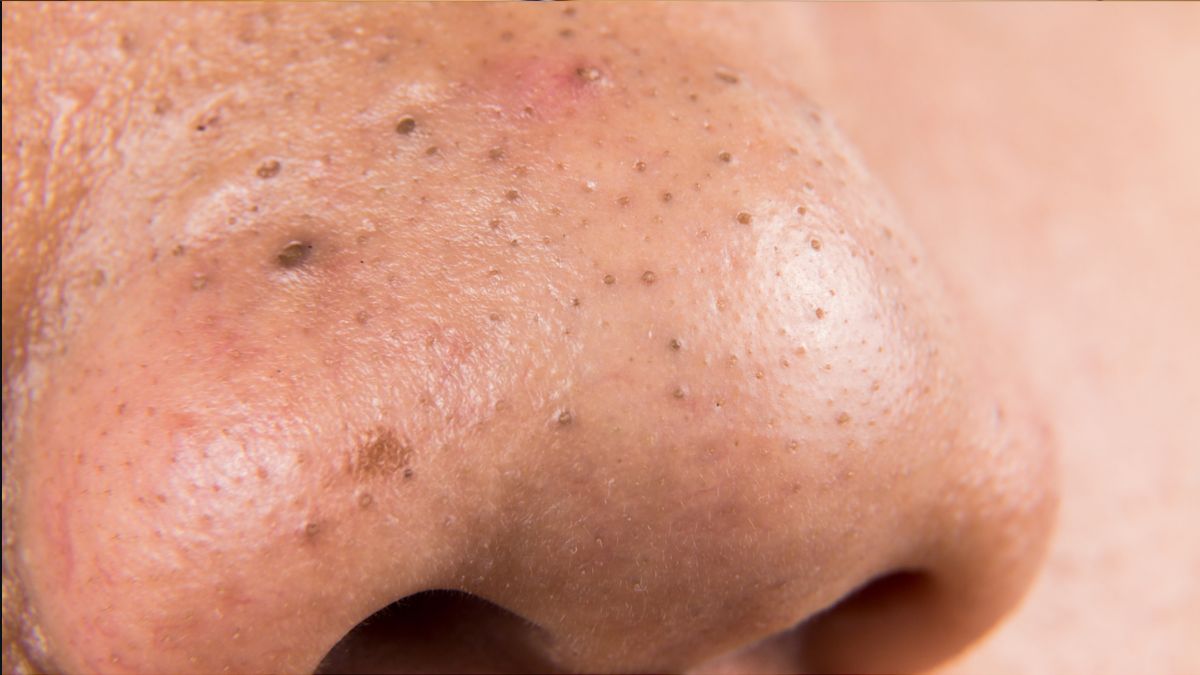 Blackheads on the Nose