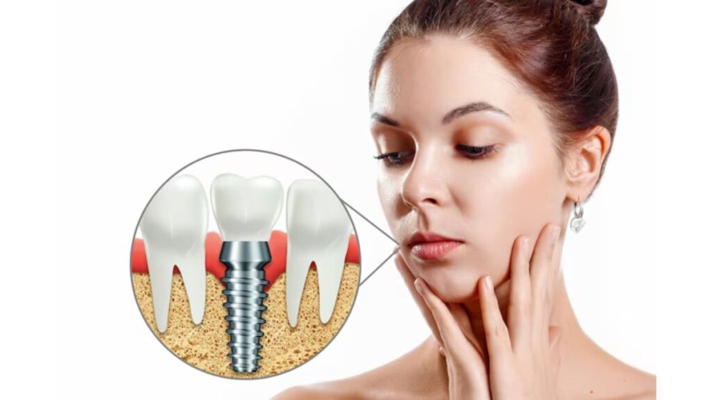 Full-Mouth Dental Implants