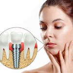 Full-Mouth Dental Implants