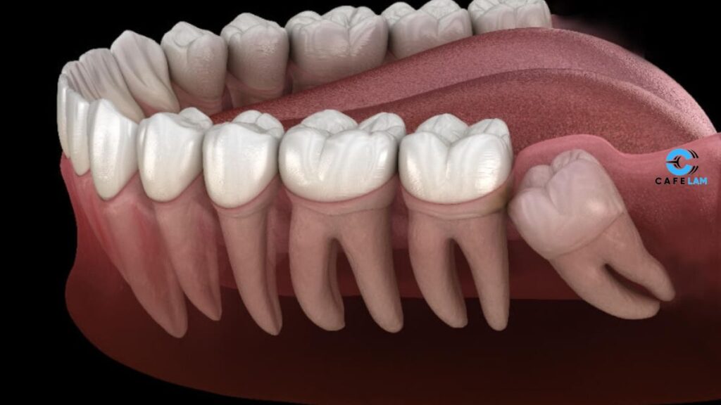 Wisdom Teeth
