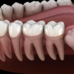 Wisdom Teeth