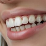Teeth Whitening